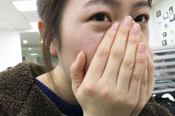 女子鼻子變大背后的健康隱患探究