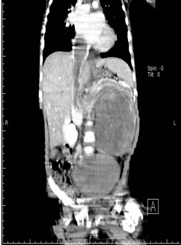 男童生吃蟹腿引發(fā)寄生蟲入侵心臟，食品安全與健康風險需警惕